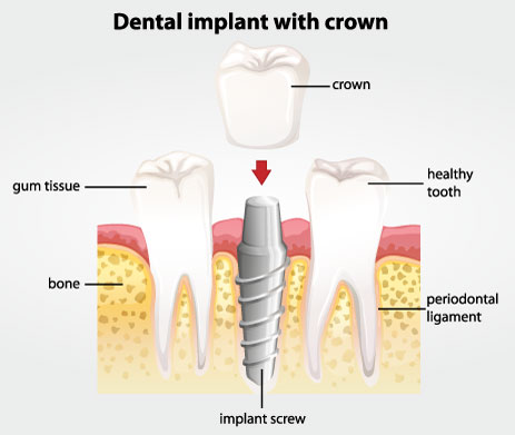 Dental implant with crown diagram