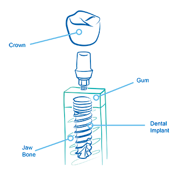 Single tooth implant sketch