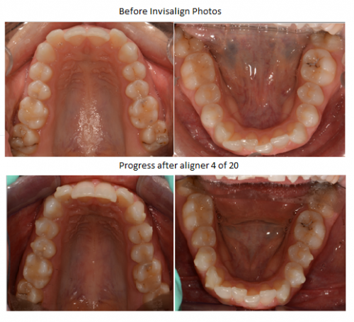 invisalign before and after, progress photo, orthodontics, braces,  straighten teeth, Invisalign, clear braces, orthodontics, cosmetic dentist, invisible braces