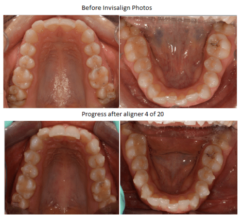 orthodontics, braces, straighten teeth