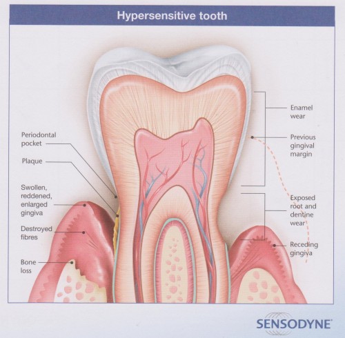 Sensitive Teeth, tooth sensitivity