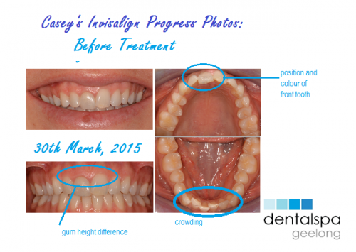 Casey's Invisalign Treatment - Dentalspa Geelong