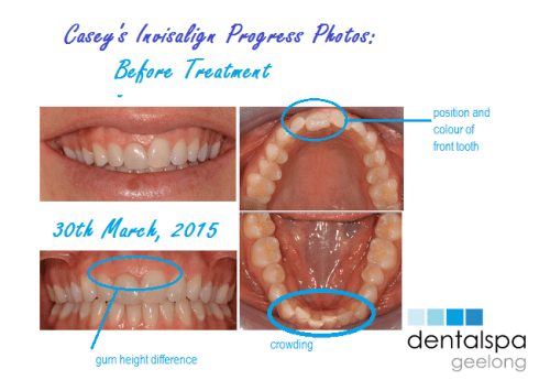 invisalign, invisalign before photos