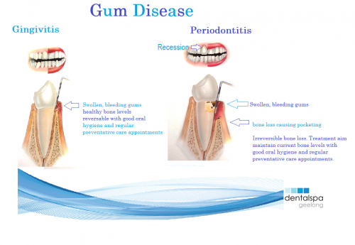 gum disease and general health, what is gum disease, bleeding gums