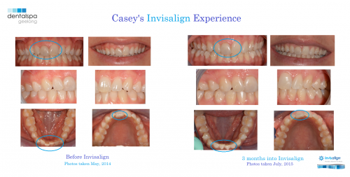 Casey Invisalign progress photos 3 months