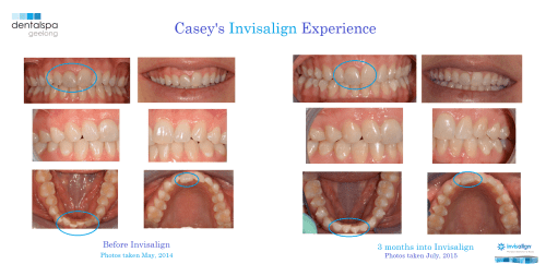 Casey Invisalign progress photos 3 months