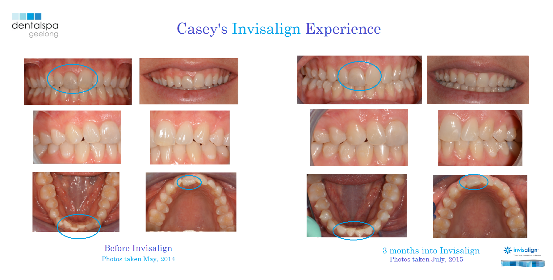 Casey's Invisalign Treatment- Part 2 - Dentalspa Geelong
