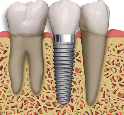 implant2