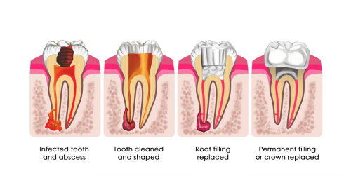 how does a crown work after a root canal