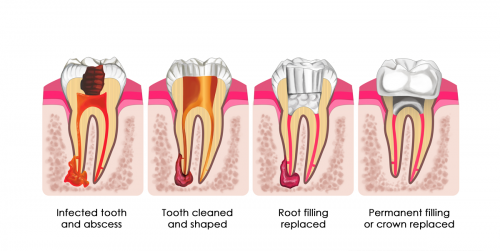 Knowing Your Dental Options Root Canal Crown Implants Dentalspa 