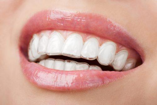 invisalign-2