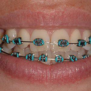 Braces