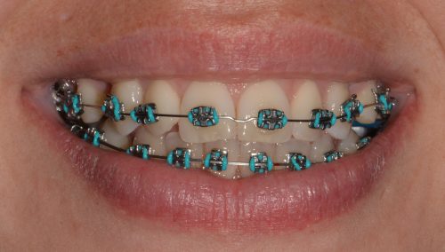 Teeth with dental braces