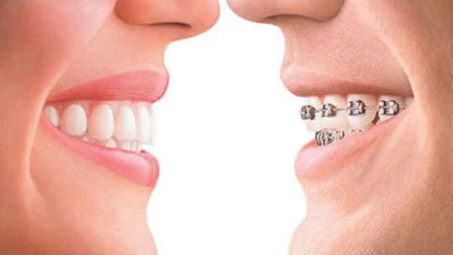invisalign-vs-braces1