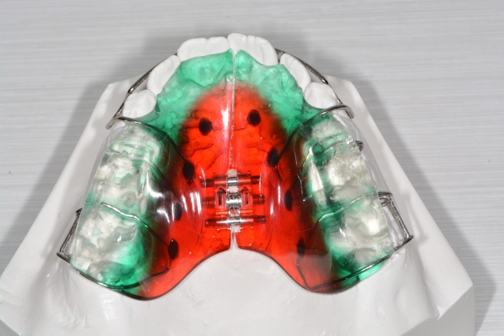 Watermelon coloured upper dental retainer