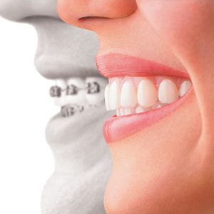 Invisalign