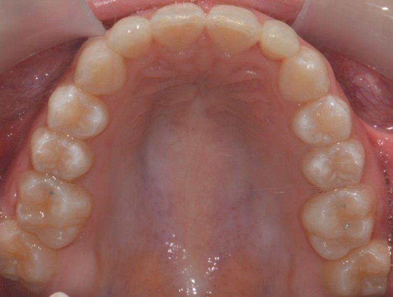 upper arch after braces Dentalspa Geelong